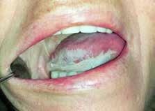 Jednou z najčastejších bielych chorobných jednotiek v ústnej dutine je leukoplakia oris a jedna z jej foriem frikčná orálna hyperkeratóza.