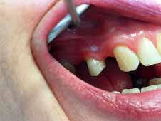 č. 4 I 2016 Zubné lekárstvo Klinický obraz. Pri vyšetrení ústnej sliznice nachádzame bielu plochu rôznej veľkosti, ktorú nie je možne zotrieť.