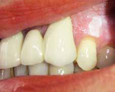 Môže postihovať: bukálnu sliznicu, často v blízkosti ústnych kútikov, chrbát jazyka, najmä v jeho prednej tretine, spodinu ústnej dutiny, podnebie (tvrdé aj mäkké), gingívu a alveolárny výbežok.