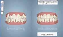 č. 4 I 2016 Zubné lekárstvo Obr. 3: Clin Check vľavo počiatočný stav chrupu, vpravo počítačová simulácia výsledku liečby. 4. Atachmenty sú malé hranaté kompozitné vyvýšeniny nalepené dočasne na zuby.