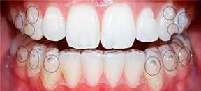 vyžadujú málo nástrojov a trvajú krátky čas; účinnosť predvídateľnosť pohybu zubov môžu znížiť celkové trvanie liečby.