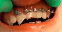 Zubné lekárstvo 4 8 5 6 7 Obr. 4: Stav po ošetrení luxačnej traumy ľavého horného rezáka, spojené s fraktúrou korunky. Zub bol 1 hodinu uchovávaný vo vlhkej fólii.