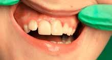 RTG snímka zhotovená bezprostredne po replantácii zuba. 6. Endodontické ošetrenie 8 dní po úraze, keď zub už nevykazoval známky vitality.