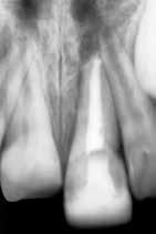 9: Externá resorpcia v mieste lomnej fraktúry koreňa horného ľavého veľkého rezáka (zub 21) v oblasti lomnej čiary po nekróze drene v korunkovom úlomku.