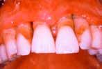 Po štandardnej lokálnej antimikrobiálnej liečbe nedochádza k zlepšeniu. HIV parodontitis v klinickom obraze okrem zápalu gingívy sú prítomné parodontálne vačky a resorpcia alveolárnej kosti.