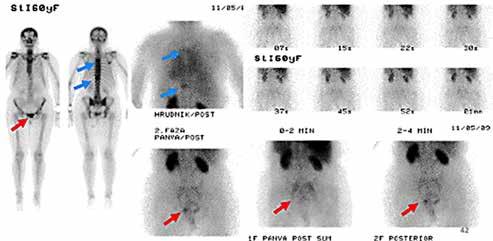Obr. č. 4. Scintigrafia prekrvenia mäkkých častí (horný riadok) a scintigrafia skeletu (dolu) ca, kým sa mohla začať liečiť. Výsledkom bolo pokročilé štádium nádoru s MTS do skeletu.