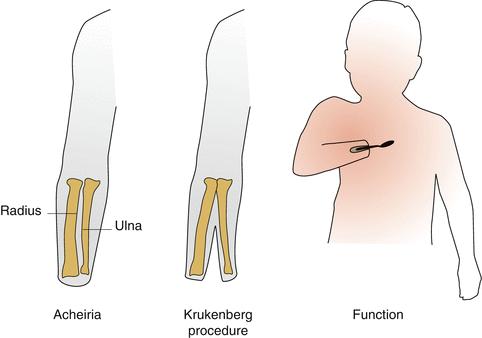 Obrázok 5. Dĺžky kýpťa po transradiálnej amputácii a korešpondujúca schopnosť pronácie/supinácie (Murphy,2013).