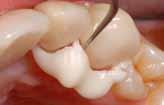leptanie ani bonding na zub 3 Efektívny režim tuhnutia s dosiahnutím