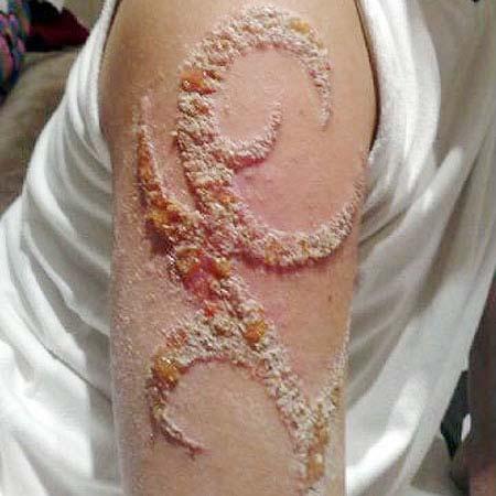 Zdravotné riziká pri dočasnom tetovaní PPD môže najmä u citlivých ľudí spôsobiť rôzne alergické reakcie, ktorých symptómy sa prejavia okamžite alebo až na niekoľko, väčšinou 3-12 dní.