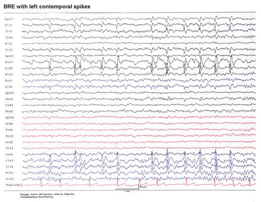 EEG 2 Meraním vzniká elektroencefalogram Nástroj