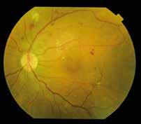 proliferatívne pruhy a membrány bez alebo s trakčným odlúpením sietnice. Diabetický edém makuly môže byť prítomný pri oboch formách diabetickej retinopatie (obr. 1).