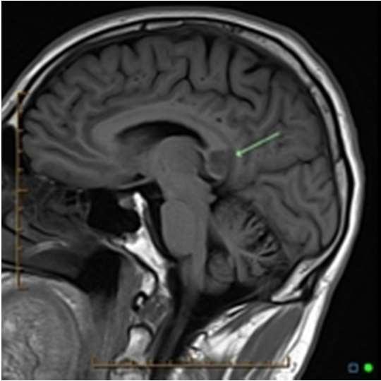 Pacient -anamnéza 20.11. 2017 MRI navigovaná biopsia intraaxiálneho tumoru prerastajúceho corpus callosum a zasahujúceho oba čelové laloky 23.11. prepustený domov s udržovacou dávkou KS 3.12.