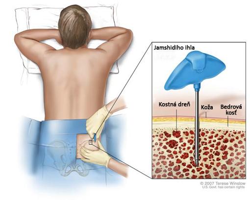 Aspirácia kostnej drene a biopsia. Potom, čo sa malá oblasť kože znecitlivie, vpichne sa Jamshidiho ihla (dlhá, dutá ihla) do pacientovej bedrovej kosti.