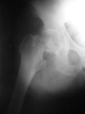 Zlomeniny proximálneho femuru Najzávažnejšia osteoporotická zlomenina S narastajúcim trendom (vrátane Slovenska) Až s 20 25% mortalitou do 1 roka po zlomenine 1 rok