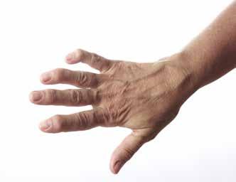REUMATODINÁ ARTRITÍDA Choroba, na ktorú nestačí zlato, má nového súpera Pre pacientov s reumatoidnou artritídou aj tie najobyčajnejšie činnosti dlho znamenali bolestivé trápenie.