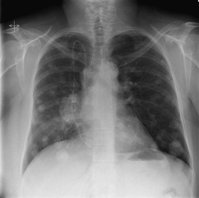 44 Kolektív: Diferenciálna diagnostika metastatického postihnutia pľúc Obr. 1. Klasická RTG snímka tzv. znak Canon-ball pľúcnych metastáz pri karcinóme prsníka (zdroj: https://radiopaedia.