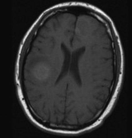 Kolektív: Diferenciálna diagnostika metastatického postihnutia pľúc 45 Obr. 4. MR obraz v transverzálnej rovine T1vo a T2vo MTS v mozgu z malígneho melanómu (zdroj: GAILLARD F.