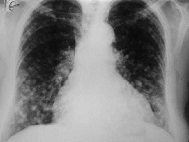pľúcnych poliach Obr. 10. USG obraz - nález hypoechogénnej lézie na pravej nadobličke Obr. 11.