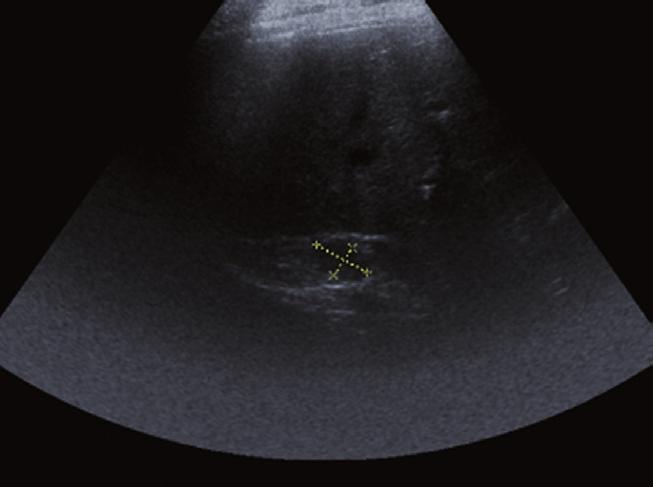 14. CT obraz MTS postihnutia pľúcneho parenchýmu s mnohopočetnými nodularitami difúzne