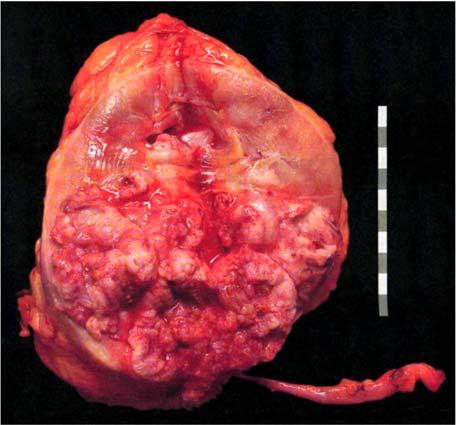Obrázok 51 Odstránená pravá oblička s močovodom nádor z urotelu vypĺňa dutý systém obličky B.