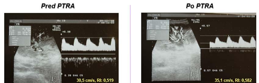 Obrázok 28 Stenóza renálnej artérie transplantovanej obličky. Vľavo hore: Oslabenie prietoku a nízke RI za stenózou. Vľavo dole: Vysoká rýchlosť v mieste stenózy renálnej artérie.