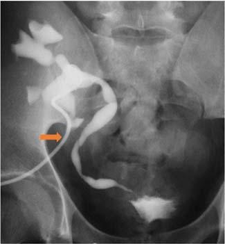 Obrázok 29 Dočasná derivácia moču pri stenóze distálneho úseku močovodu transplantovanej obličky (šípkou vyznačená nefrostómia) Obrázok 30 Urinóm pri nekróze distálneho úseku močovodu