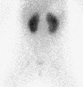 Obrázok 38Normálny gamagrafický obraz obličiek predná projekcia Obrázok 39Dystopia ľavej obličky oblička je uložená nižšie, ako je fyziologické (obrázok vľavo predná projekcia, obrázok vpravo zadná