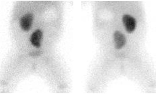 parametrov, separovanú funkciu obličiek (podiel ľavej a pravej obličky na celkovej funkcii) a hodnotu celkovej glomerulovej filtrácie (GF).