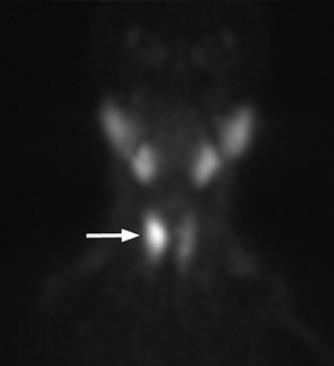 Obrázok 40 Adenóm pravého horného prištítneho telieska (šípka) zobrazenie v skorej fáze Tc99m-MIBI. Vyššie uložené ložiská so zvýšenou aktivitou, resp. vychytávaním rádionuklidu v slinných žľazách 1.
