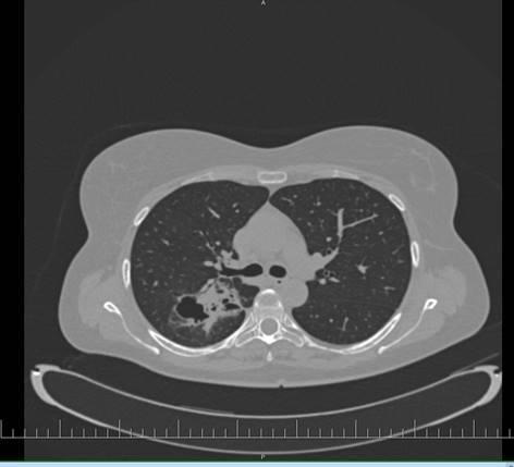 Pľúcna aspergilóza u zdravotnej sestry 46 ročná zdravotná sestra 7 rokov pracuje na KAIM prvé príznaky pľúcneho ochorenia 03/18 dlhodobo liečená ATB pneumológom (nález S.