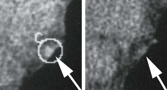 12 DOKUMENTÁCIA Klinický dôkaz získaný od pacientov s koronárnou chorobou srdca Prvýkrát v histórii medicíny bolo pomocou CT snímok (ultrarýchlej počítačovej tomografie) zdokumentované prirodzené