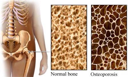 OSTEOPORÓZA redukcia kostnej 