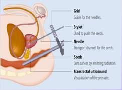 Postup pri implantácii 125 I zŕn stanovenie diagnózy určenie veľkosti prostaty objednanie zŕn aplikácia fixácia prostaty pomocou 2 špeciálnych