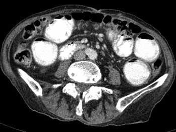 62 Kazuistiky Obrázok 3. CT brucha so zobrazením distendovaných črevných kľučiek v transverzálnych skenoch Obrázok 4.
