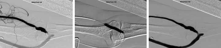 48 Prehľadové články né tlaky vedú k výraznému poškodeniu žily, čo má často za následok restenózu v mieste PTA.