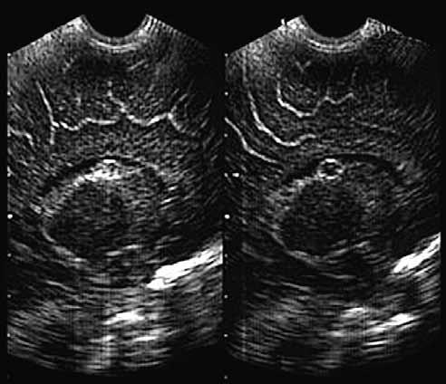 50 Kolektív: Ultrazvukové vyšetrenie mozgu novorodencov a dojčiat Donosení asfyktickí novorodenci s kortikálnou atrofiou môžu mať v budúcnosti viacpočetné ťažké poškodenia, ale aj mierne vývojové