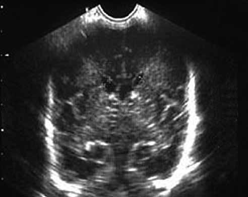 52 Kolektív: Ultrazvukové vyšetrenie mozgu novorodencov a dojčiat Obr. 9.