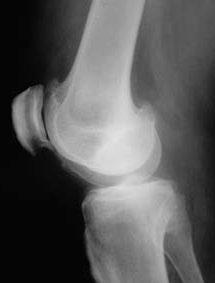 kĺbových povrchov, poškodenie a stuhnutie väzov, deštrukcia kosti v oblasti kĺbu, kde nie je nádej na odstránenie