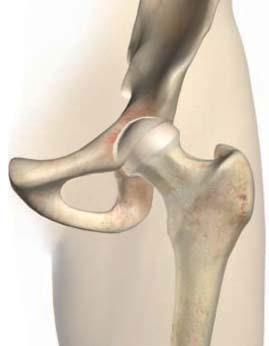 Bedrový kĺb a jeho anatómia Možnosti ošetrenia bedrového kĺbu Z čoho sa skladá bedrový kĺb? Bedrový kĺb tvorí horná časť stehennej kosti (femur) a jamka panvovej kosti (acetabulum).