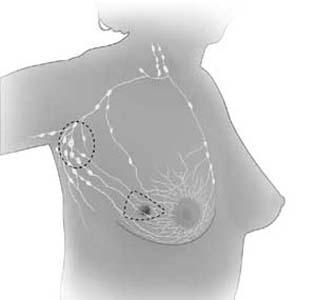 MBC - Metastatic Breast Cancer Axilárne uzliny Kostná dre Periférna krv Prítomnos