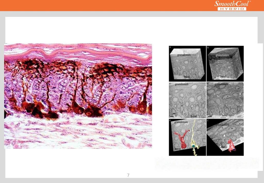 Čo sú melanocyty? Obr. 2. 3D štruktúra melanocytov v epidermálnej vrstve u pacientov s melazmou, obrázky (a), (c) a (e) pred ošetrením laserom a obrázky (b), (d) a (f) obrázky po ošetrení laserom.