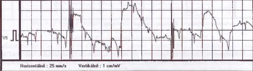 Obr. 2.9: Frekvenčné spektrum rušenia (drift) [8] Tento typ rušenia jednoducho odstránime FIR filtrom hornou priepusťou s meznou frekvenciu napríklad 2 Hz. 2.5.
