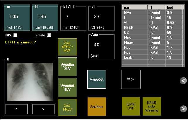 AutoStart Obrázok 4. Okno je určené na rýchle nastavenie ventilačných parametrov nového pacienta. Systém umožňuje viacero stupňov nastavenia.