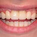 Rýchly a jednoduchý bez potreby leptania a bondovania na zub Gumená konzistencia, ktorá umožñuje jednoduché odstránenie prebytoëného materiálu Prakticky žiadna pooperaëná senzitivita: dobré riešenie