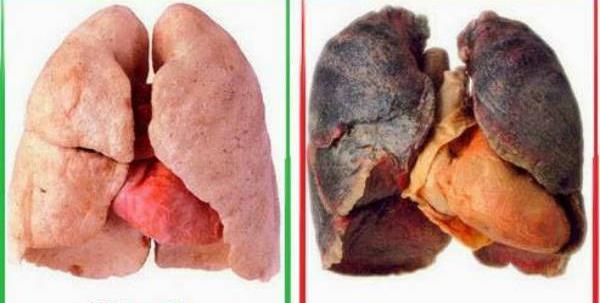 Pľúca nefajčiara (vľavo) a pľúca fajčiara (vpravo). Dlhodobé účinky nikotínu na srdcovo-cievny systém sa podieľajú na vzniku aterosklerózy a nedokrvenia ciev dolných končatín.