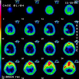 1. Scintigrafia mozgu - SPECT METASTÁZA 56 r. pacientka s dg. malígny melanóm IV.