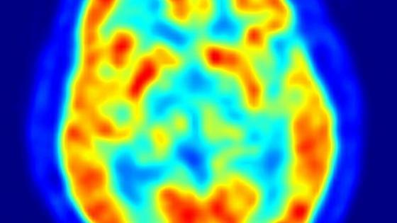 Umelá inteligencia a zobrazovanie V nukleárnej medicíne boli použité algoritmy umelej inteligencie (AI) trénované rozlišovaním 2100 obrazov 18F-FDG PET mozgu u