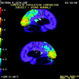 2. Regionálny prietok krvi mozgom - rcbf Následky po ťažkej traume posúdenie