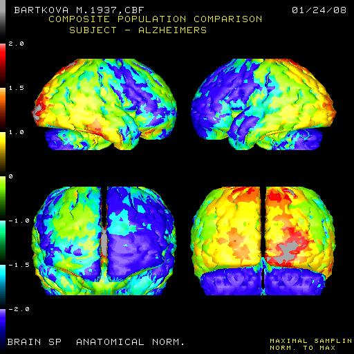 2. Regionálny prietok krvi mozgom - rcbf Diferenciálna diagnostika demencie Pri porovnaní databáz Alzheimerov (A) a starších normálov (B) vidno parietálne oblasti, ktoré