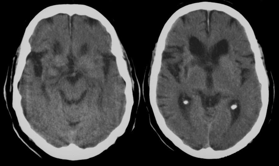Scintigrafia receptorov mozgu DaT scan